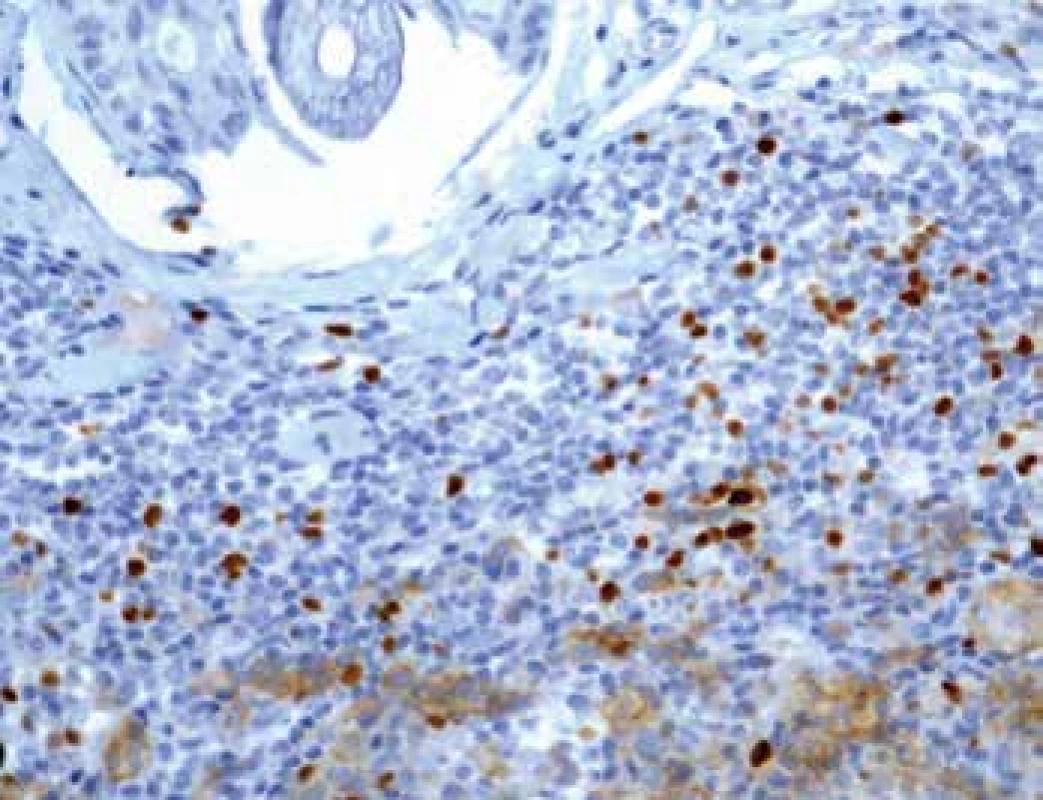 Imunohistochemický průkaz protilátky anti-FOXP3 u T regulačních
lymfocytů na periferii tumoru (zvětšení 200x).