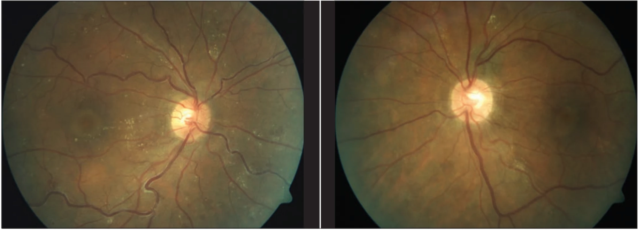 Nález na fundu obou očí s časovým odstupem po laserové koagulaci sítnice: vstřebání retinálních hemoragií, částečně
i tvrdých exsudátů, vény již méně dilatované a tortuózní