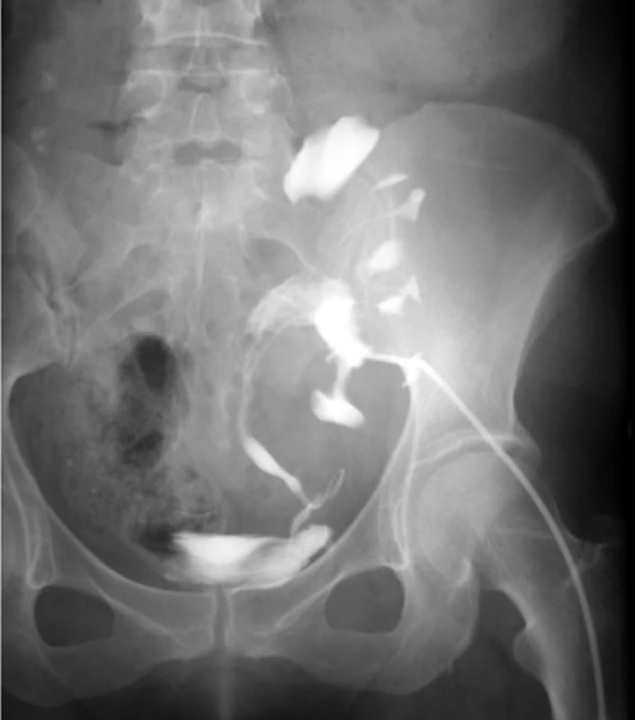 Pyelo-ureterografia. Dlhý zalomený močovod
transplantovanej obličky<br>
Fig. 9. Pyelo-ureterography. A long, kinked ureter of
the transplanted kidney