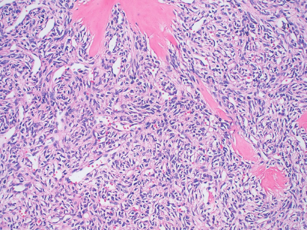 Histomorfologický charakter lézie s oválnymi a vretenovitými
bunkami usporiadanými v storiformných vzoroch (farbenie
hematoxylín a eozín, zväčšenie 200x).