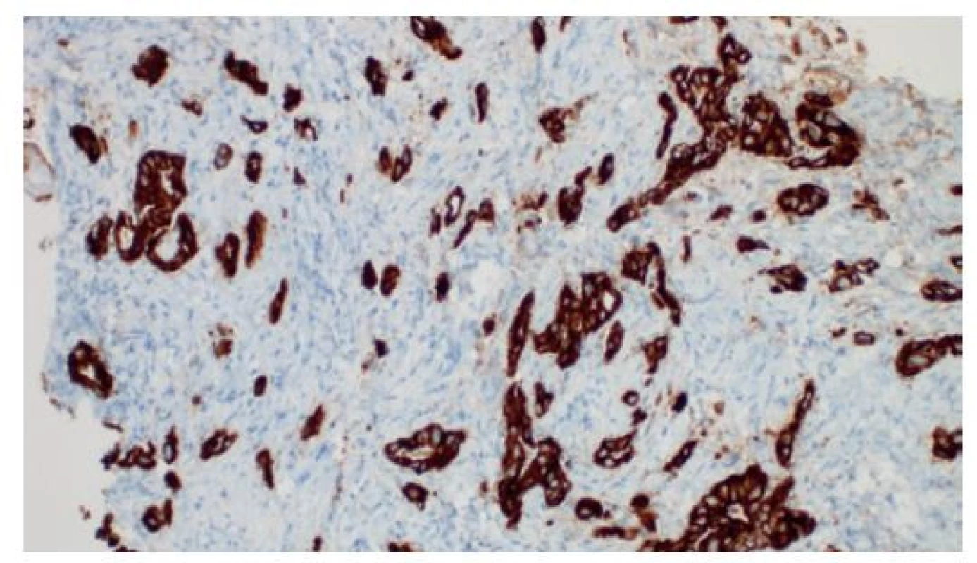 Imunohistochemická pozitivita žlázového cytokeratinu
19 v disociovaném a rudimentárně glandulárním adenokarcinomu
v cholangioskopické biopsii, je patrný budding
(„pučení“) jednotlivých nádorových buněk a drobných shluků
v desmoplastickém stromatu, imunohistochemie, 200×<br>
Fig. 8: Positivity of glandular cytokeratin 19 based on immunohistochemistry
in the dissociated and essentially
glandular adenocarcinoma from a cholangioscopy biopsy;
budding of individual cancer cells and small clusters along
with stromal desmoplasia, immunohistochemistry, 200×