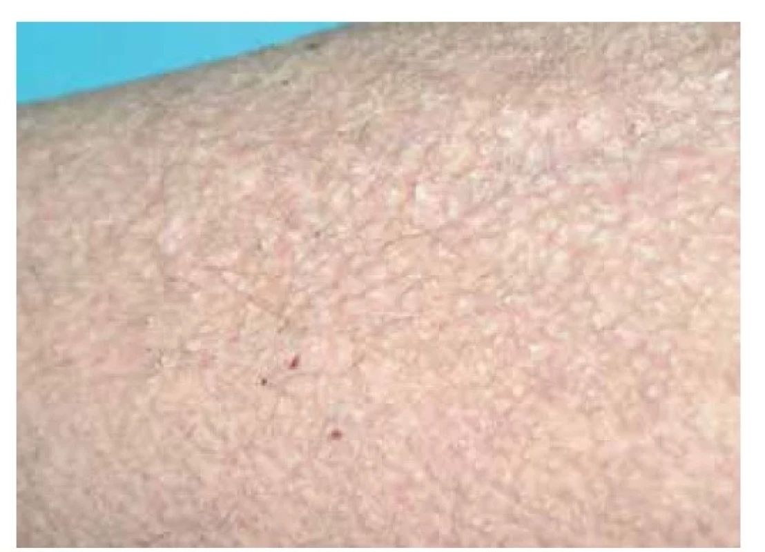 Lichen amyloidosus – klinický obraz