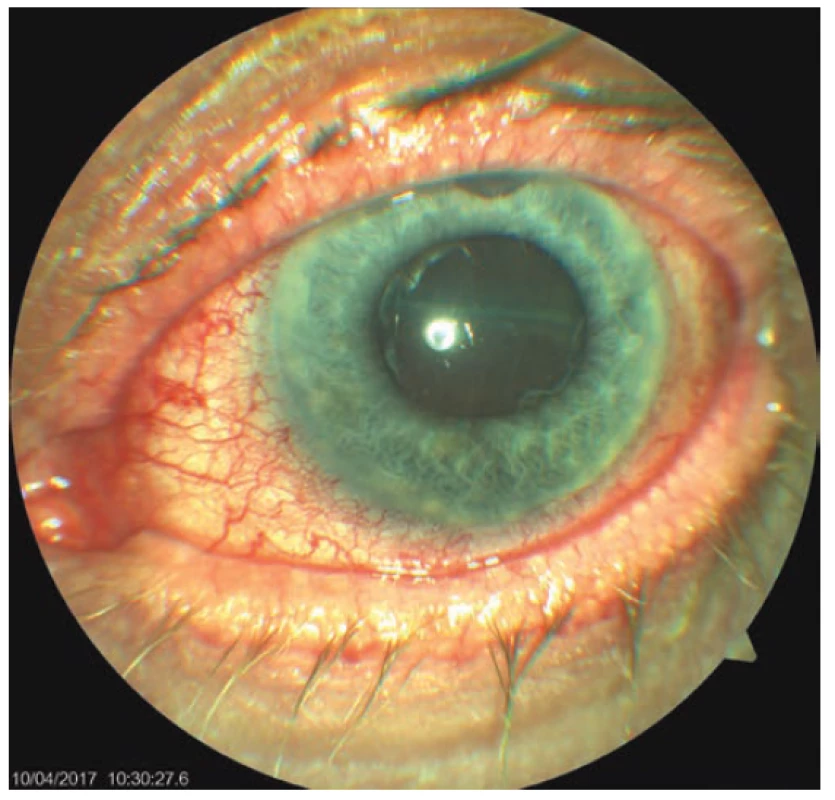 Objektivní nález levého oka 7. den po trabekulektomii
(TE) OL