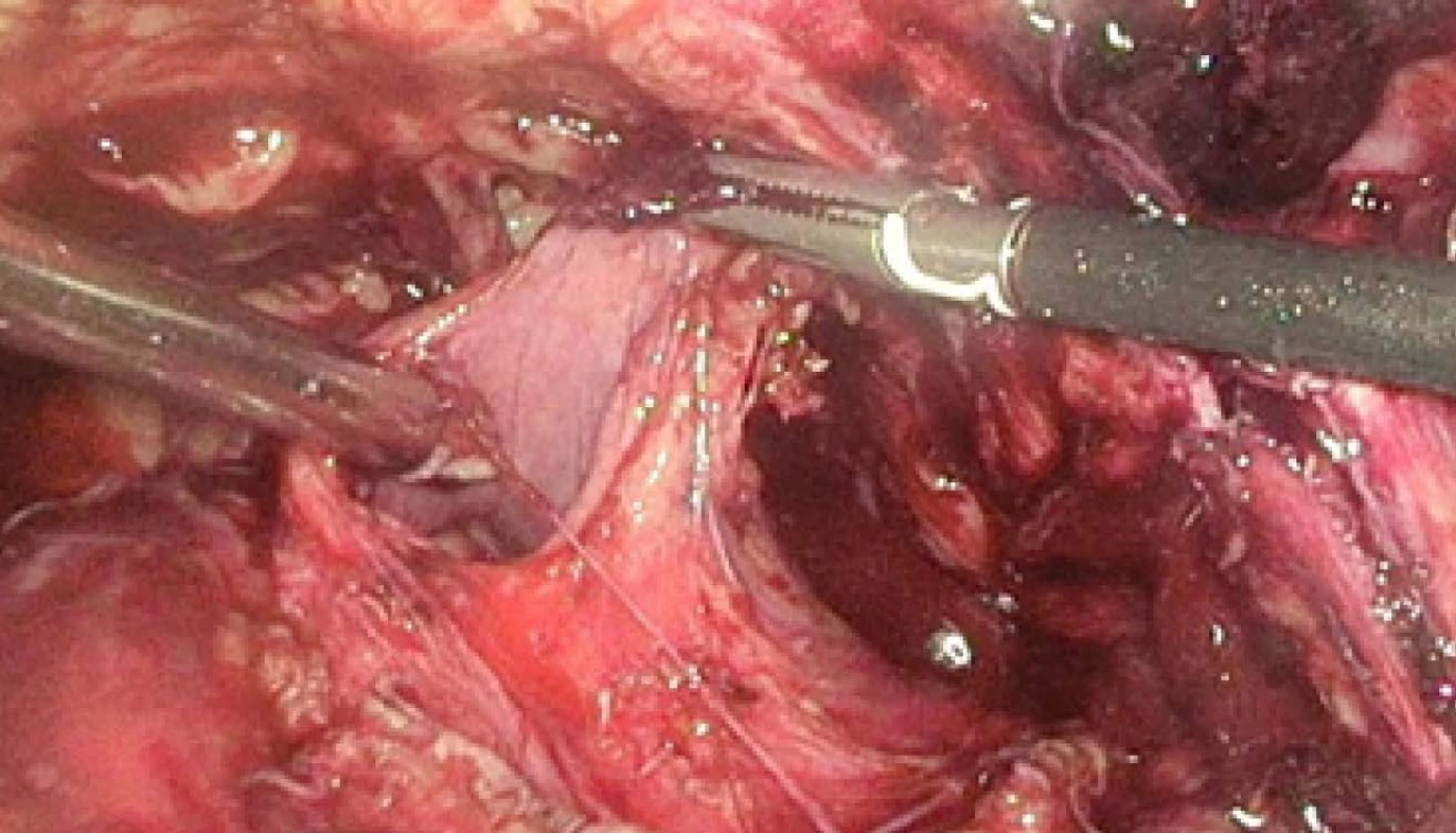Laparoskopie – ruptura
pravé strany močového
měchýře<br>
Fig. 5. Laparoscopy – rupture
of the right side of the
urinary bladder