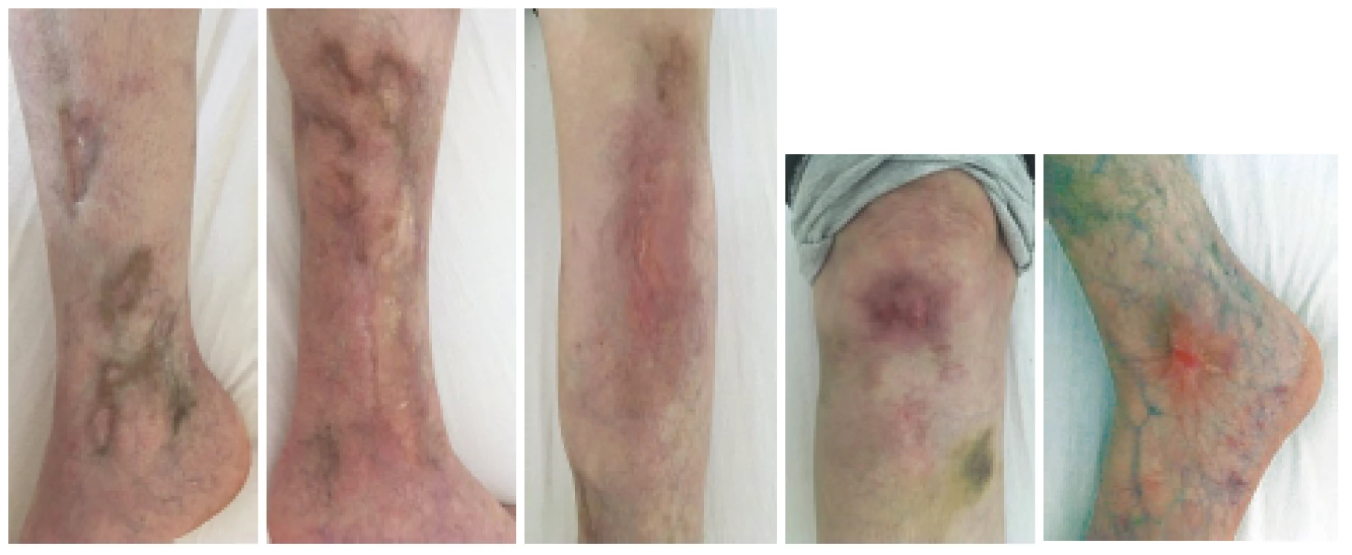 Definitivní zhojení kožní vaskulitidy v květnu 2019 při poslední hospitalizaci v RÚ. Celkem bylo podáno od 11/2017 deset pulzů
cyklofosfamidu v kumulativní dávce 4,1 g.