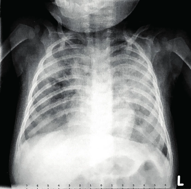 RTG hrudníku RAG2 SCID pacienta ve věku 5 měsíců.<br>
a) Snížená transparence levého plicního křídla a výraznější zastření pravého plicního křídla, zejména v pravém horním laloku (průkaz rhinovirů v nasofaryngu
metodou PCR)<br>
b) Akcentace snížené transparence levého plicního
křídla a další výraznější zastření pravého plicního křídla s odstupem 10 dnů (průkaz Pneumocystis jirovecii
v nasofaryngu metodou PCR)<br>
Fig. 2. Chest X-ray of 5-months-old RAG2 SCID patient.<br>
a) Decreased transparency of the left lung and increased density of the right lung, particularly in right
upper lobe (rhinovirus PCR positivity in nasopharynx)<br>
b) Accentuation of decreased transparency of the
left lung with progression of density of the right lung
after 10 days (Pneumocystis jirovecii PCR positivity in
nasopharynx)