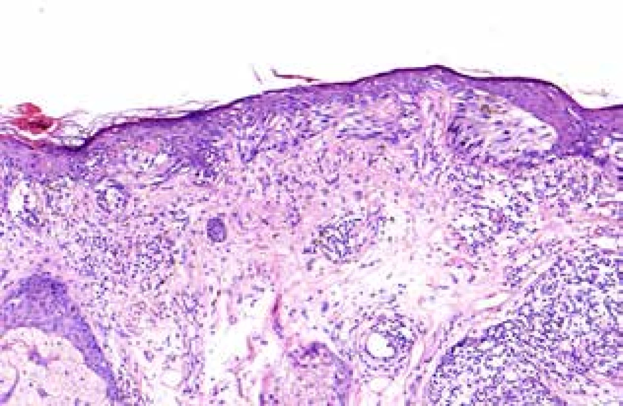 Lentigo maligna melanoma – obrázek zachycuje zejména junkční složku, nedokumentuje složku dermální LMM