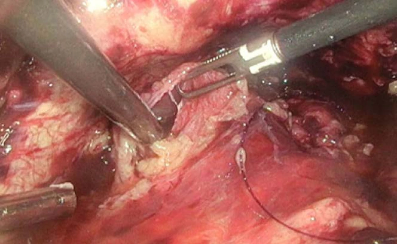 Laparoskopie – na
levé straně další ruptura močového
měchýře<br>
Fig. 6. Laparoscopy – On
left side of the urinary bladder,
the next rupture.
