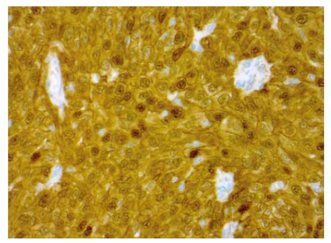 Imunohistochemický průkaz nukleární a cytoplazmatické pozitivity
beta kateinu v nádorové afekci (zvětšení 400x).