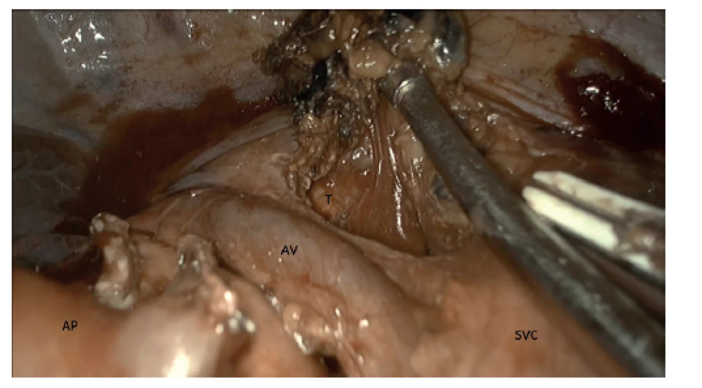 Uniportal VATS horní lobektomie pravé plíce, mediastinální
lymfadenektomie sk. 2R, 4R en block. Prostor
mezi venou azygos (AV), tracheou (T), horní dutou žilou
(SVC) a aortou. Plicní tepna (AP)<br>
Fig. 3: Uniportal VATS right upper lobectomy, mediastinal
lymphadenectomy 2R+4R en bloc. Space defined by the
azygos vein (AV), trachea (T), superior vena cava (SVC)
and aorta. Pulmonary artery (AP)