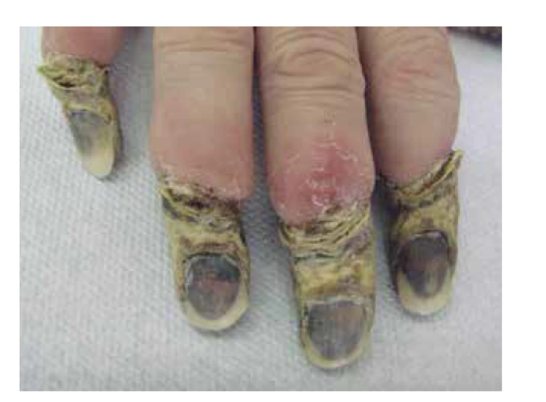 Suchá gangréna distálních článků rukou u pacientky
s kryoglobulinemickou vaskulitidou