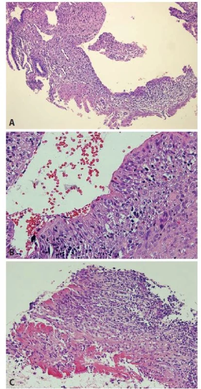 Synovial-like metaplasia of the endometrium, histological features.
A. At low power, polypoid fragment with surface synovial-like layer of the cells
is seen (case 1). B. Synovial-like cells are arranged perpendicular to the endometrial
cavity (case 1). C. Inflammatory infiltrates in the stroma and fibrin on
the surface (case 2) (original magnifications 100x, 400x and 200x, respectively).