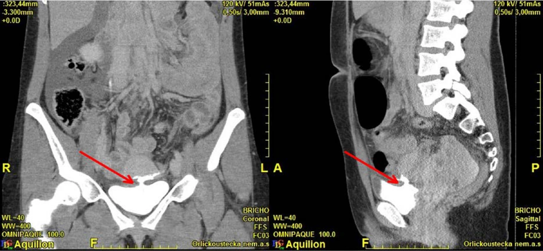 CT, koronární a sagitální řez: intraperitoneální perforace močového měchýře<br>
Fig. 5. CT, coronal and sagittal plane: intraperitoneal bladder perforation