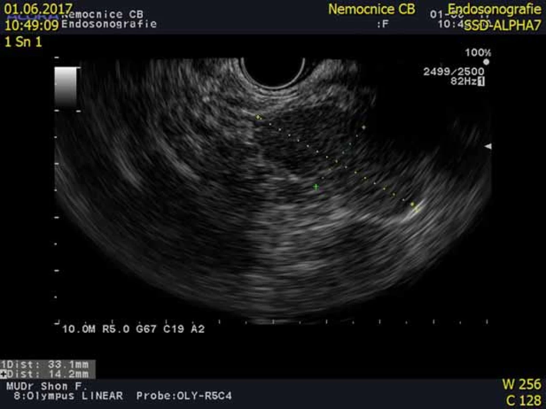 Endoskopická ultrasonografi e pankreatu s obrazem intrapankreaticky
uložené akcesorní sleziny (IPAS).
Fig. 5. An endoscopic ultrasound scan showing an intrapancreatic accessory
spleen (IPAS).