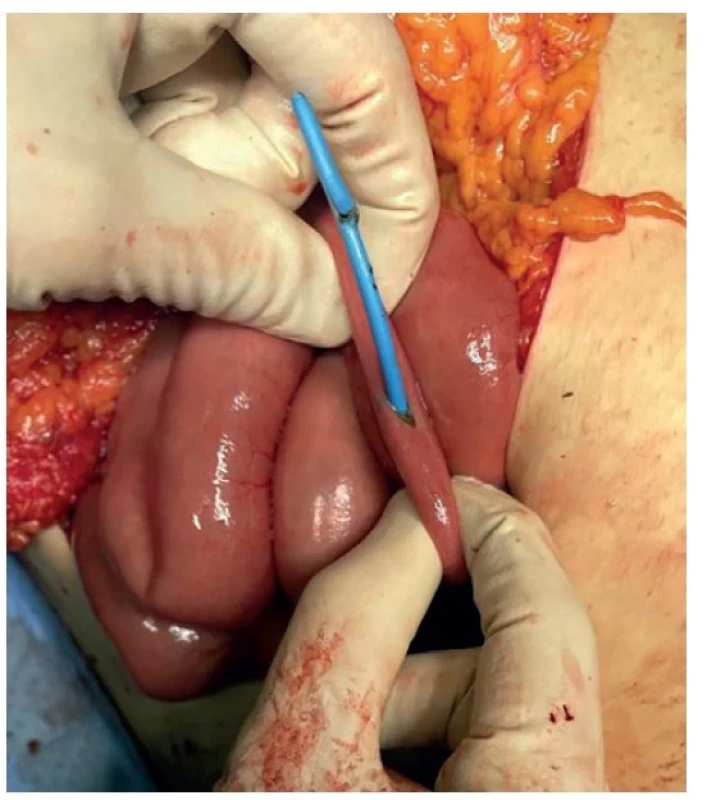 Dislokovaný drén vyhledán a odstraněn peroperačně
z enterotomie<br>
Fig.5: Localization and removal of the dislocated drain by
enterotomy