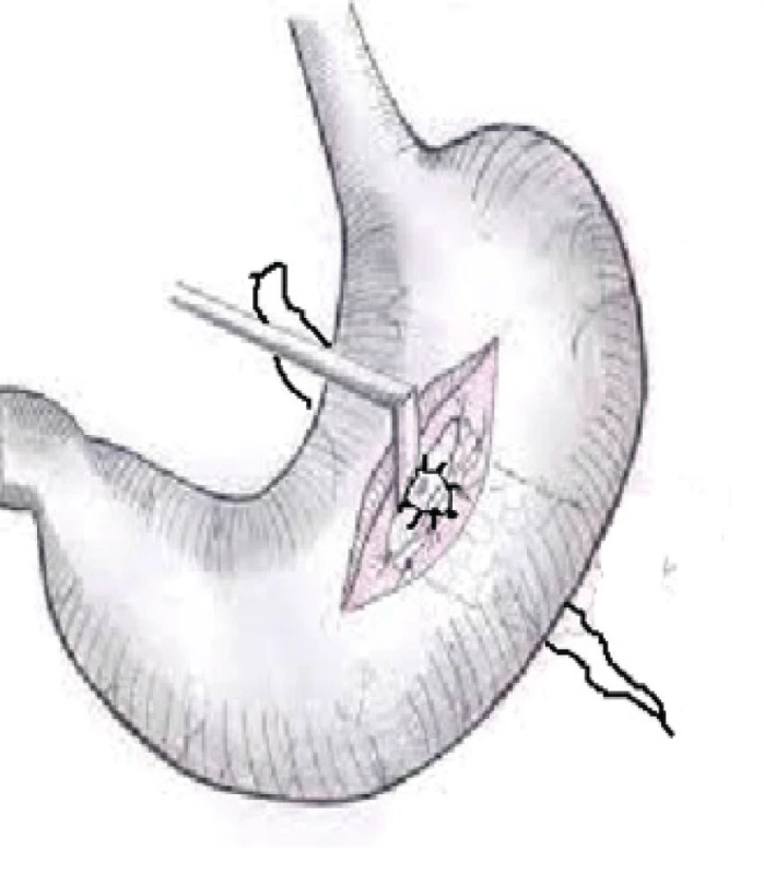 Gastrofistuloanastomóza<br>
Fig. 3. Gastrofistuloanastomosis