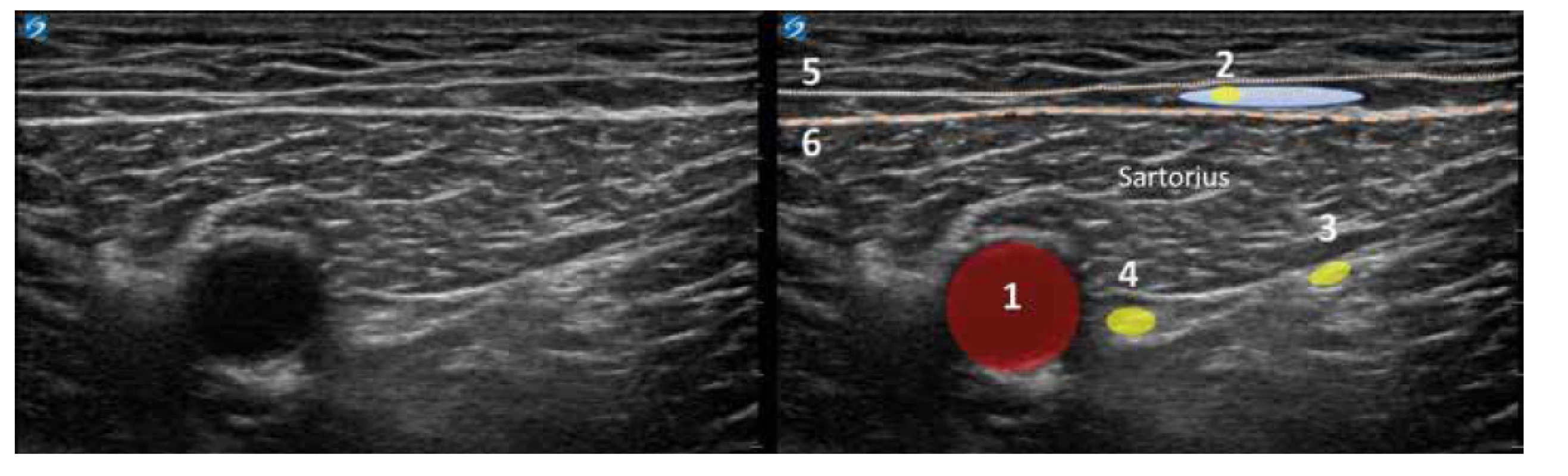 Nativní a kolorovaný ultrazvukový obraz v trigonum femorale. 1. arterie femoralis, 2. NCFIM, modrou barvou naznačeno lokální anestetikum,
3. n. vastus medialis, 4. nervus femoralis, 5. povrchní fascie stehna, 6. fascia lata