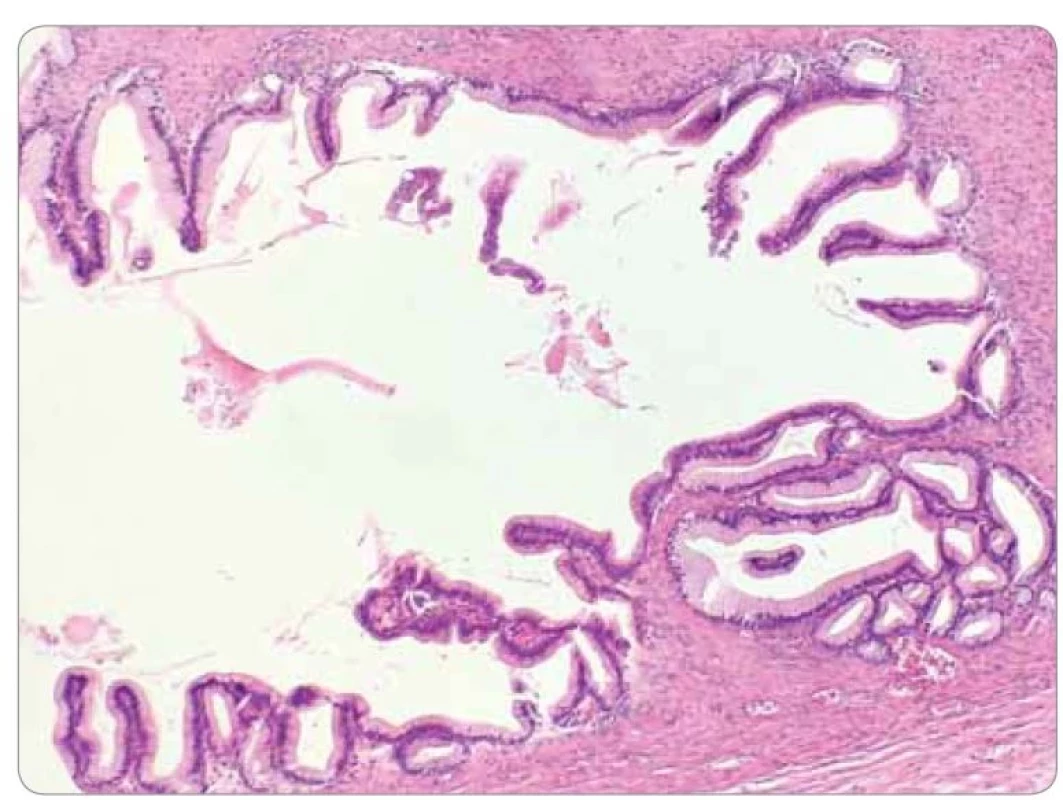 Luminálna výstelka tumoru tvorená jednovrstvovým hlienotvorným epitelom
(farbenie hematoxylín & eozín, zväčšenie 20×).