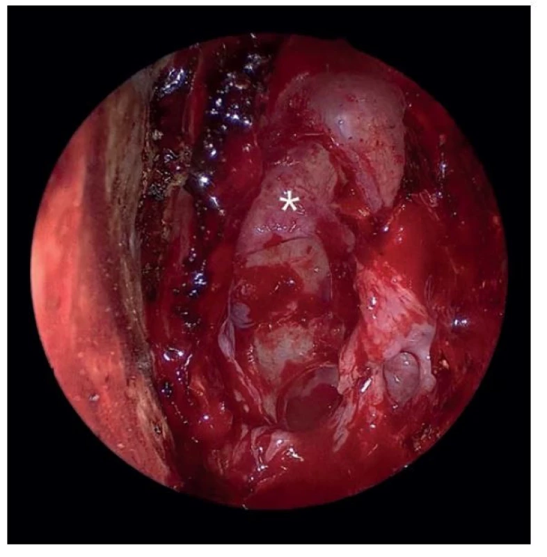Přehledné operační pole, čichové sklípky (hvězda), levá nosní dutina, endoskopický pohled