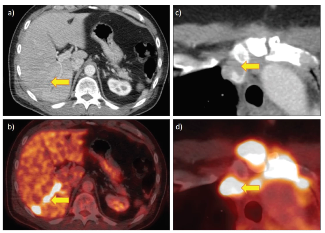 FDG PET/CT s hypermetabolickými nádorovými tromby (bez histologické verifikace, s progresí v dalším sledování):
a) a b) nádorová trombóza větve porty jako jediná manifestace metastatického postižení jater u 51letého pacienta s kolorektálním karcinomem,
c) a d) nádorový trombus v žilní náhradě u 54leté pacientky s generalizovaným thymomem