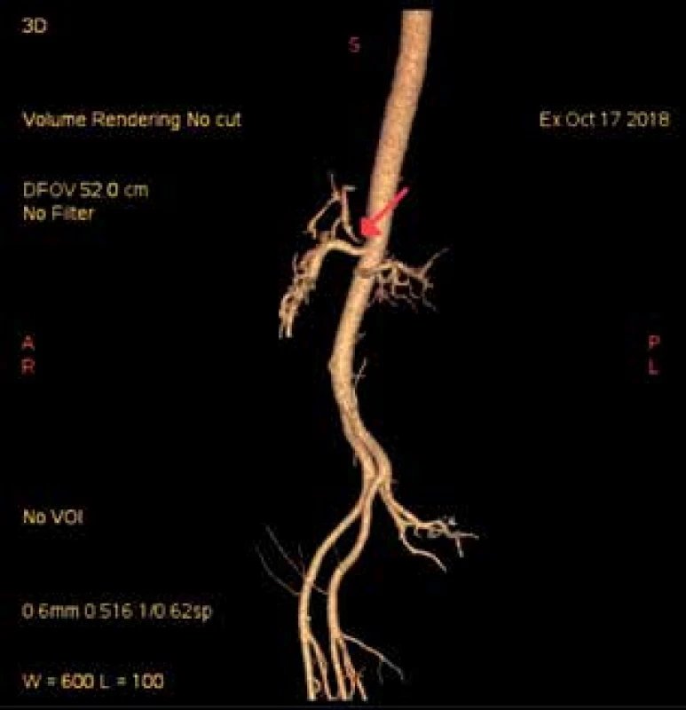 CT angiografie s nálezem stenózy kmene TC u prezentovaného pacienta (označeno šipkou)<br>
Fig. 2: CT angiography with the finding of TC stenosis in 
the presented patient (marked by the arrow)