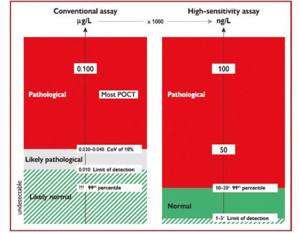 Rozdíly mezi konvenční analýzou (vlevo – hodnoceno v μg/l)
a vysoce senzitivní analýzou srdečního troponinu (vpravo – hodnoceno
v ng/l), pouze vysoce senzitivní analýza umožňuje rozlišení mezi normálními
a patologickými hodnotami (podle 1)