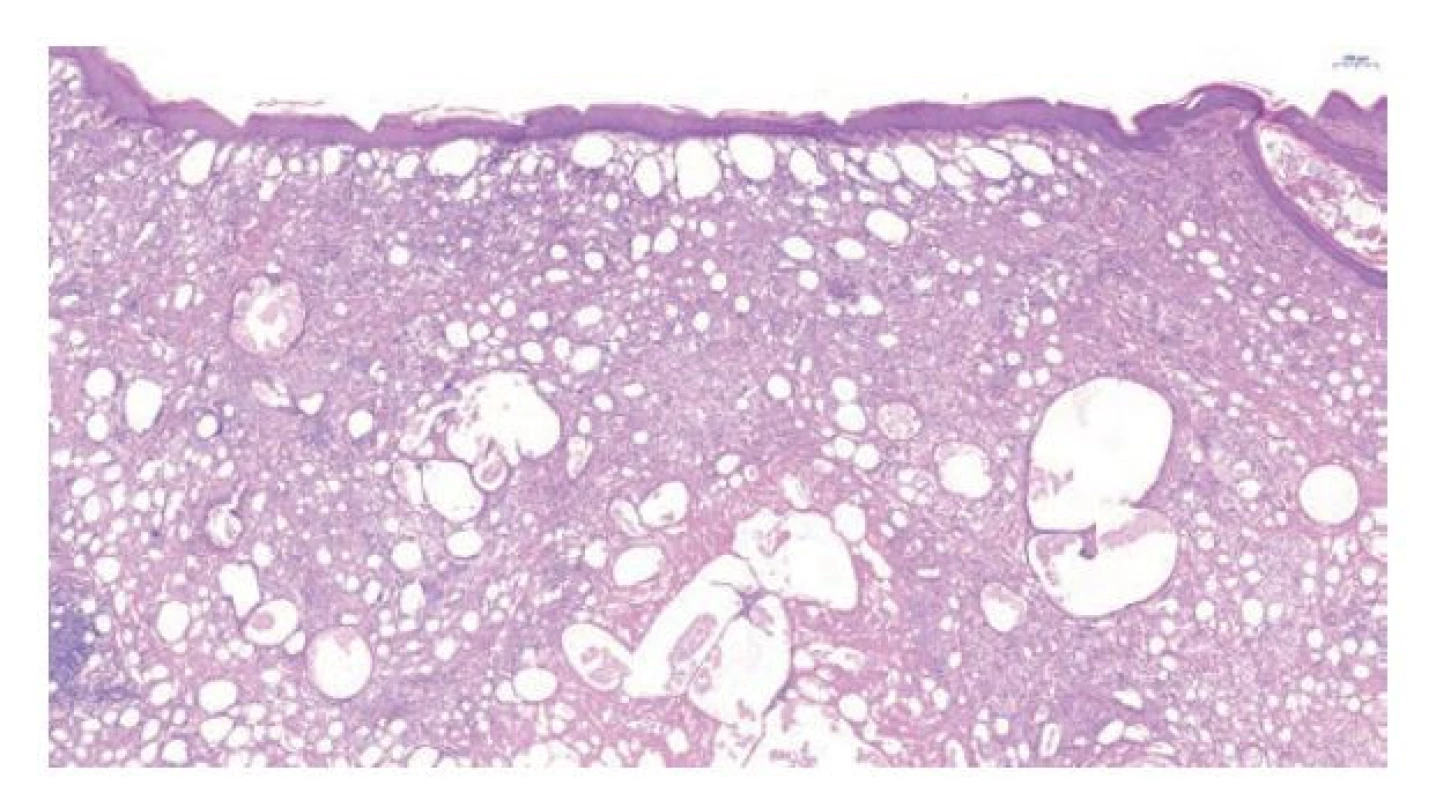 Histologie kůže penisu zobrazující množství opticky prázdných prostor
v dermis odpovídající extracelulárním kapénkám/jezírkům parafínu
vmezeřeným mezi kolagenní vlákna. Hematoxylin eosin, 4.2x.