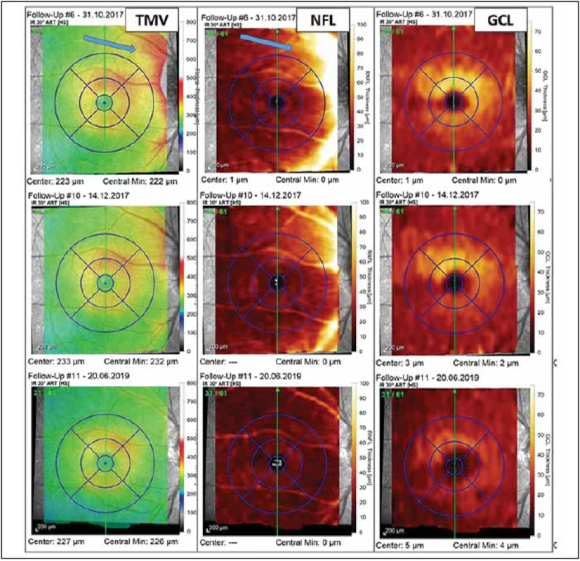 Vyšetření makuly pomocí optické koherenční tomografi e u pacientky s probíhající optickou neuritidou u neuromyelitis optica
a onemocnění jejího širšího spektra. Barevná legenda tloušťky vyšetřované vrstvy je ve sloupci vpravo u každé mapy. V prvním
sloupci jsou výsledky měření TMV, v prostředním sloupci je tloušťka vrstvy NFL a v pravém sloupci je tloušťka vrstvy GCL. U prvního
vyšetření z 31. 10. 2017 (v prvním řádku), které bylo provedeno krátce po počátku příznaků optické neuritidy, pozorujeme známky
peripapilárního edému zasahujícího do NFL a TMV (modré šipky). Vyšetření provedené s odstupem 6 týdnů (výsledky ve druhém
řádku) již ukazuje mírné tenčení vrstvy GCL a ústup peripapilárního edému. Ve třetím řádku je vyšetření provedené s odstupem od
optické neuritidy (v červnu 2019), kde můžeme pozorovat ztrátu NFL a GCL ve všech segmentech makuly a s tím spojené snížení TMV.<br>
Fig. 3. Optical coherence tomography assessment of macula in a patient with optic neuritis in neuromyelitis optica spectrum
disorders. The thickness of retinal layers is color-coded to the right of each map. The fi rst column shows the measurement of TMV, the
middle column shows the thickness of NFL, and the thickness of GCL is in the column on the right. The fi rst assessment was performed
in October 2017 shortly after the fi rst symptoms of optic neuritis and reveals peripapillary edema (blue arrows) aff ecting the NFL and
TMV (results in the fi rst row). The assessment performed six weeks later shows thinning of GCL and decrease of peripapillary edema
(results in the second row). The fi nal assessment shown was performed in June 2019 and shows loss of NFL and GCL in all macular
segments and related decrease of TMV.