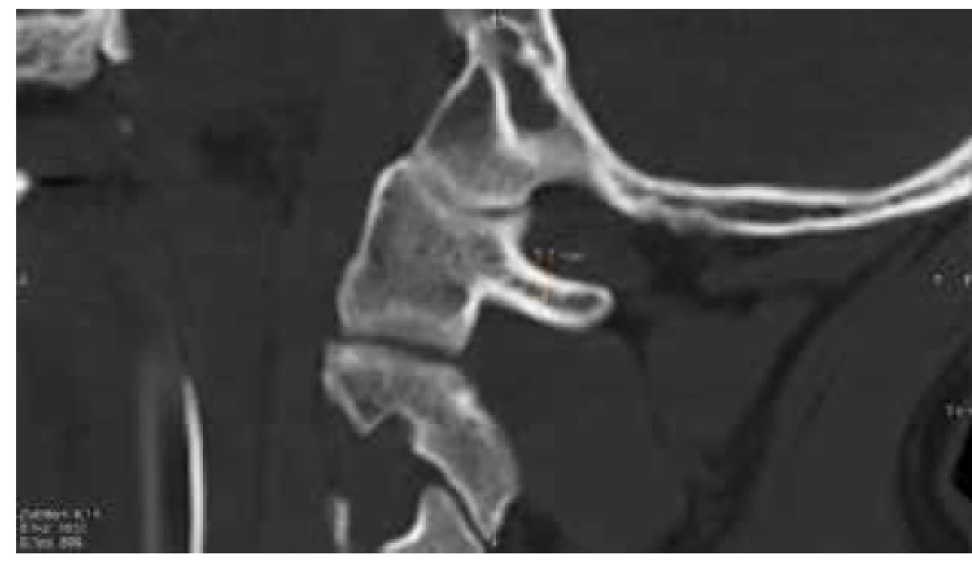 Reformátovaný CT snímek zobrazuje napojení zadního
oblouku atlasu. Doplněna hodnota kranio-kaudálního
rozměru inzerce v oblasti pod probíhající vertebrální
tepnou<br>
Fig. 2. Reformatted CT scan of the attachment of posterior
arch of atlas, including the minimum cranio-caudal
distace just bellow the vertebral artery groove