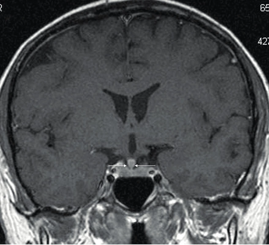 MR mozku u nemocného s ECD zachycující infiltraci stopky
hypofýzy