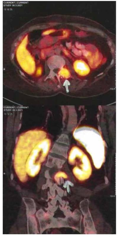 68Ga DOTA TATE PET/CT – fosfaturický mezenchýmový tumor