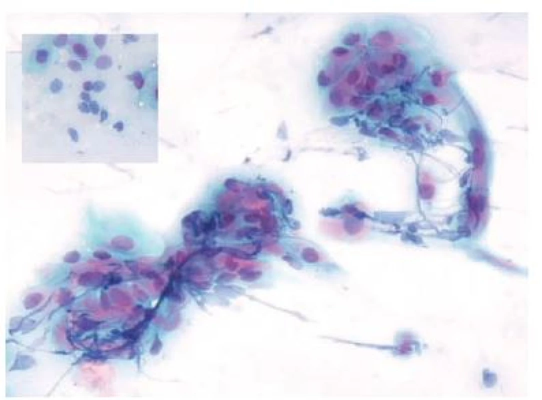 Dětská klidová fáze. Parabazální buňky přítomny ve shlucích i jednotlivě
(vložený obrázek), někdy se jeví pouze jako holá jádra. Papanicolaou,
200x.