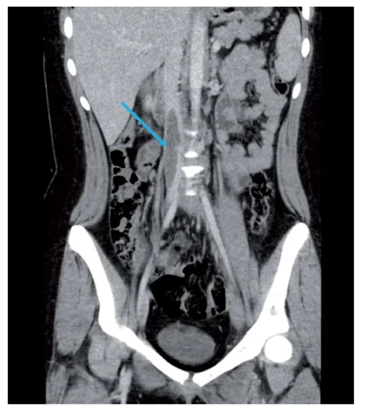 CT břicha a pánve ve venózní fázi, trombus dolní duté žíly