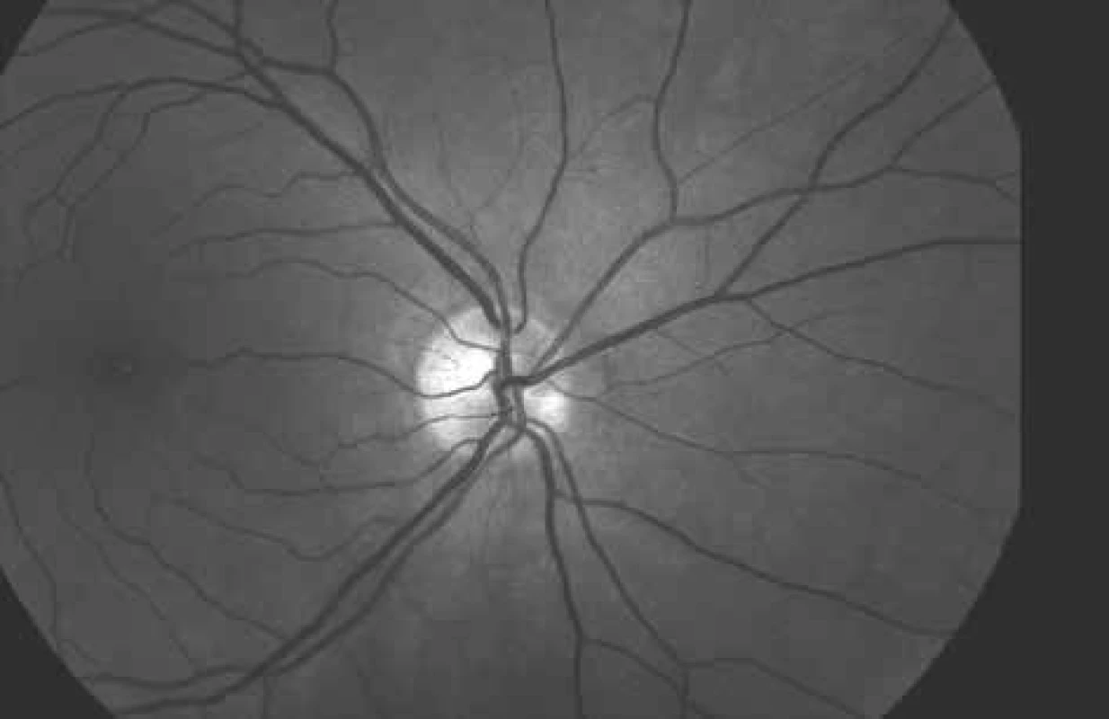 Photograph of ocular fundus at wavelength of 570 nm (same area as on Fig.
2 and 4).