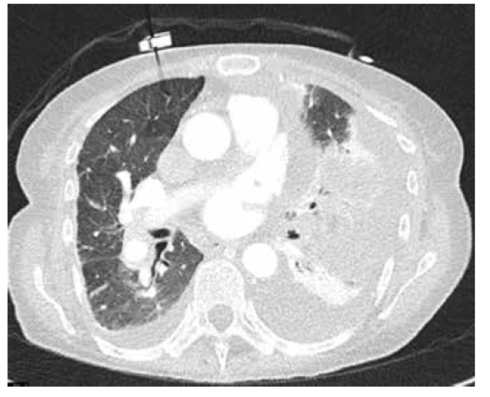 CT plic s nálezem plicního infarktu