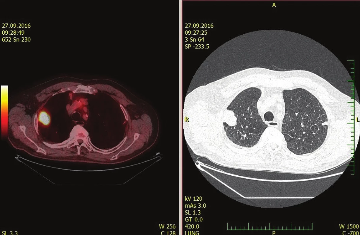 Suspektní metastáza/karcinom na PET/CT trupu<br>
Fig. 4: Suspected meta/carcinoma in PET/CT of the trunk