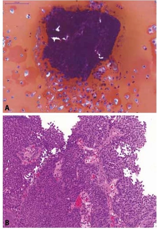 Pacientka s makroskopickou hematurií a dilatací dutého systému
levé ledviny na USG.<br>
(A) Selektivní výplachová cytologie z levého močovodu; na krevnatém pozadí
jsou urotelie z hlubších vrstev sliznice (osamoceně i v plachtovitých
shlucích) a 3D trsy urotelií (bez fibrovaskulárního stromatu) s minimálním
morfologickou alterací; kategorie: NHGUC, avšak přítomnost low-grade léze
je vysoce suspektní.<br>
(B) Definitivní histologický materiál od pacientky (TURT s odstupem dvou
měsíců po cytologii); zastižen neinvazivní exofyticky rostoucí uroteliální karcinom,
dle WHO 1973 grade 1, dle WHO 2016 low-grade neinvazivní papilární
uroteliální karcinom.