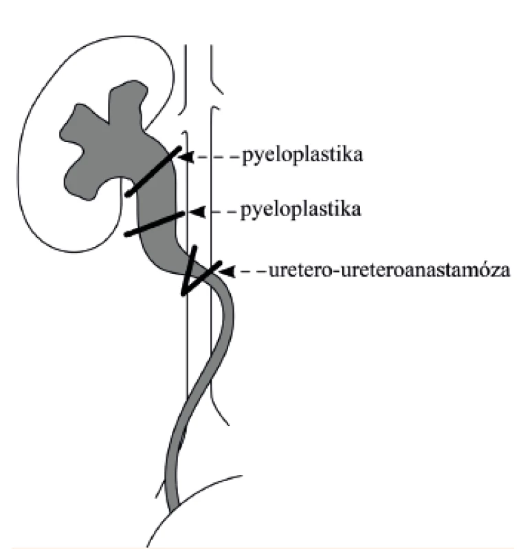 Schematické znázornění nejčastěji provázených operačních korekcí retrokaválního ureteru – pyeloplastika a uretero-ureteroanastamóza (převzato a volně upraveno podle [1]).