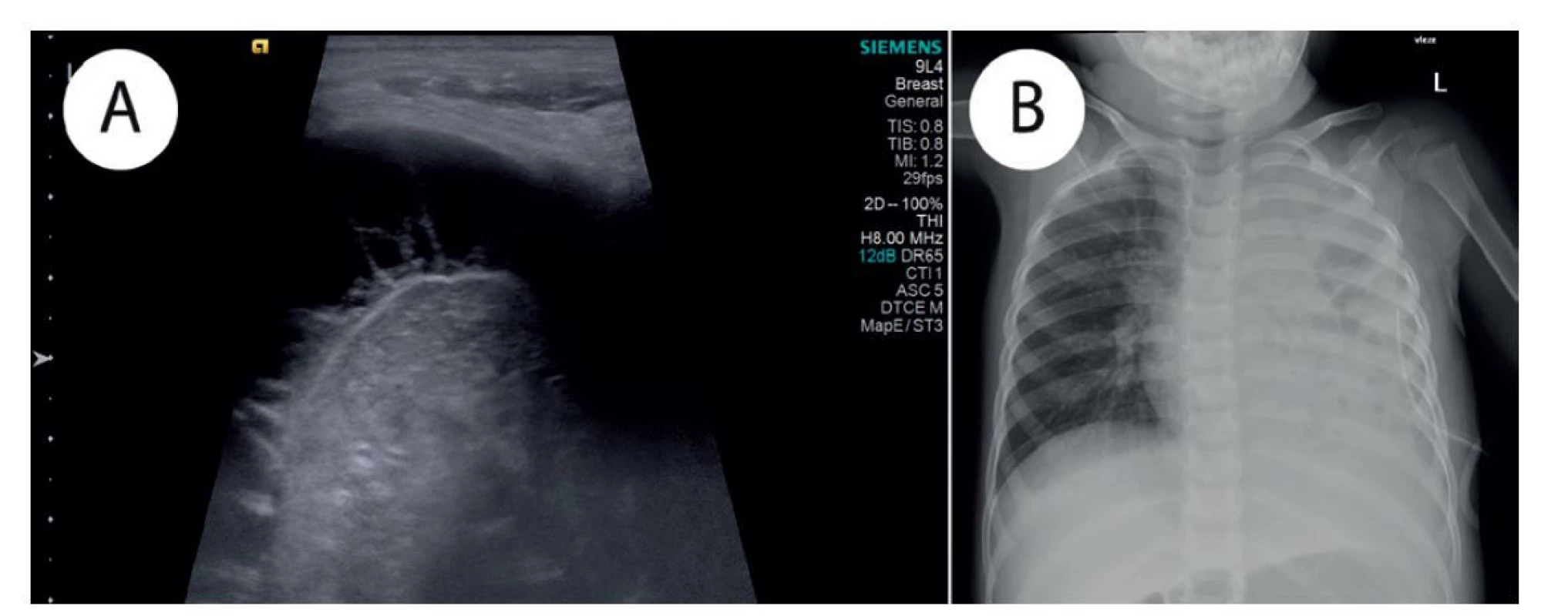a) Ultrazvukové vyšetření − septovaný pleurální výpotek; b) Prostý RTG snímek hrudníku v AP projekci, vleže −
subtotální zastření levého hemithoraxu s okrsky projasnění na podkladě rozpadu plicního křídla a pleurálního výpotku;
zavedený hrudní drén.<br>
Fig. 1: a) Ultrasound examination − septated pleural effusion; b) Plain chest radiograph, AP view, supine − subtotal
opacification of left hemithorax with small lucencies based on necrotizing pneumonitis and pleural effusion; chest tube
in place.
