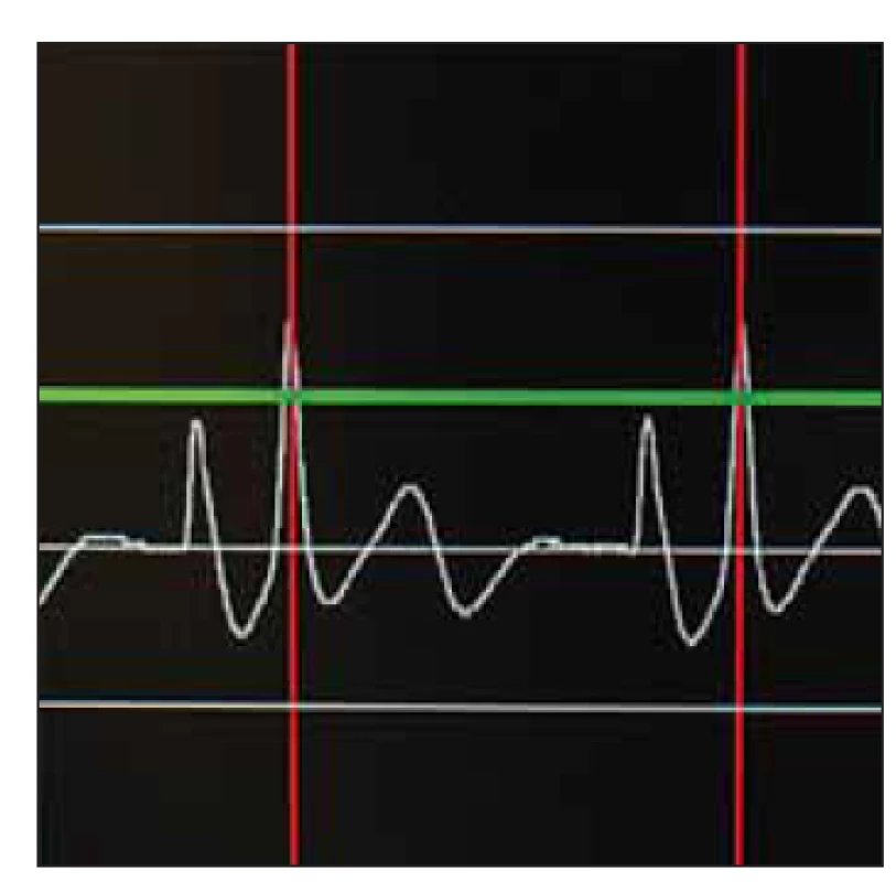 Intravazální EKG, dosažení
maximální amplitudy vlny P při
kavoatriální poloze konce katetru.