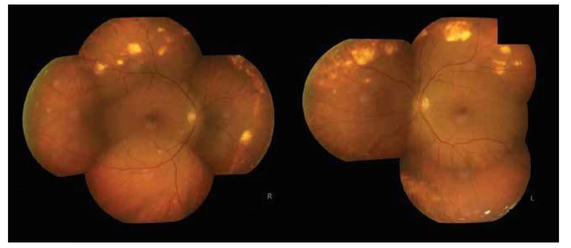 Fotografia očného pozadia (pravé oko po antiVEGF liečbe) – v strednej periférii horného temporálneho a nazálneho
kvadrantu vidno početné sklérochoroidálne kalcifikácie
