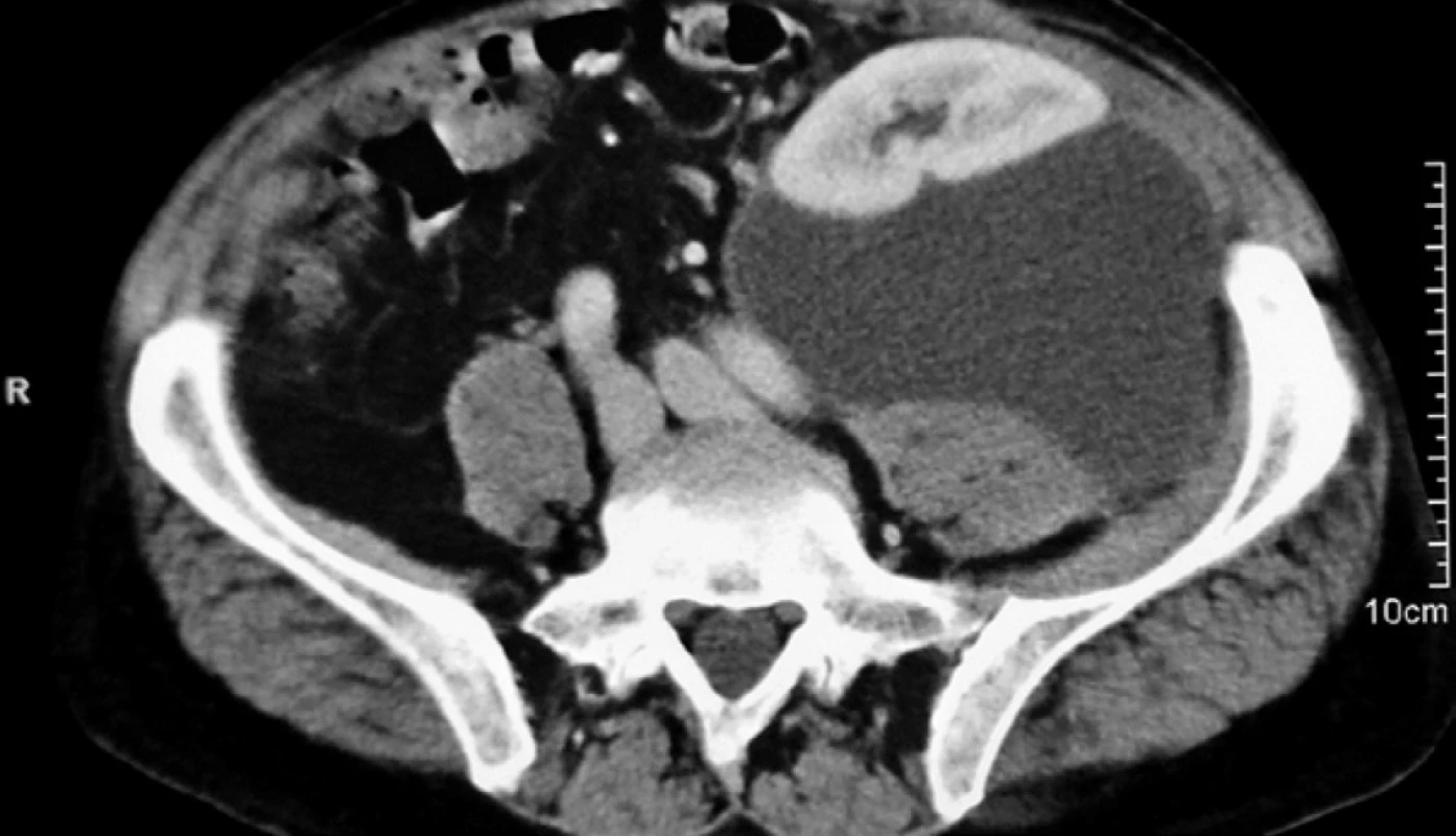 Lymfokela dyslokujúca transplantovanú obličku<br>
Fig. 3. A lymphocele displacing the transplanted kidney