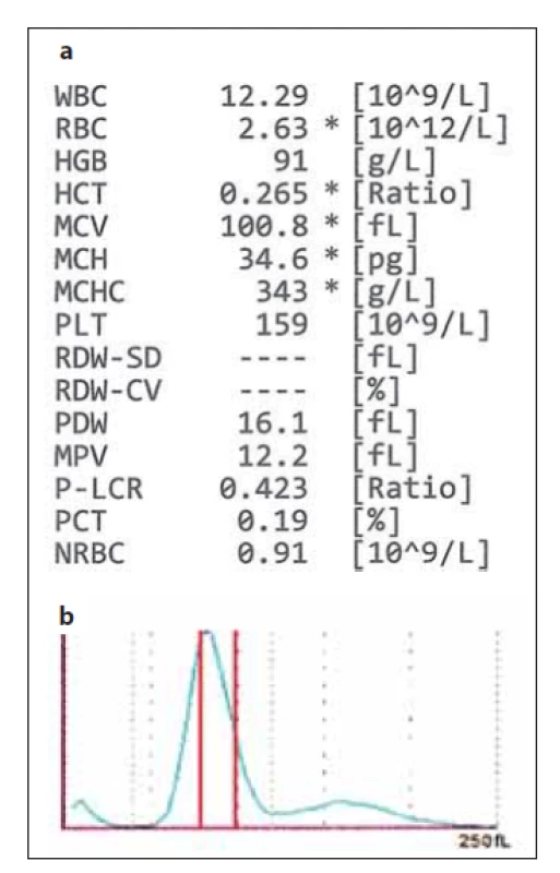 (a) Hodnoty krevního obrazu
z analyzátoru Sysmex XN-10 v případě,
kdy analyzátor vydal hlášení
o přítomnosti dimorfní populace RBC;
hodnoty červeného krevního obrazu
jsou označeny hvězdičkou * – znakem
snížené spolehlivosti. (b) Histogram
RBC – analyzátor vydal hlášení o abnormální
distribuci RBC a dimorfní
populaci erytrocytů; červenými čarami
jsou vyznačeny referenční meze
MCV (zdroj: laboratoř IV. IHK).<br>
RBC – erytrocyty, MCV – střední objem
erytrocytů