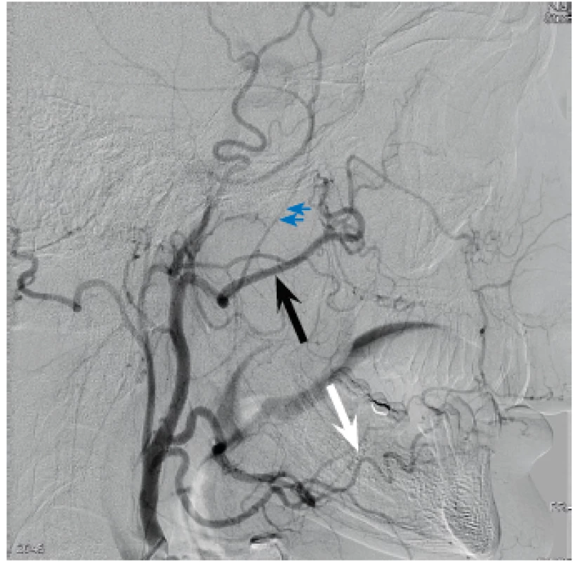 Angiografie ACE - zobrazí dominantní zásobení nosní
sliznice, a. maxillaris (černá šipka), a. facialis (bílá šipka) a vyloučí
důležité spojky do intrakraniáního povodí, zároveň verifikujeme
důležitý bod – odstup a.meningea accesoria (modrá dvojitá šipka),