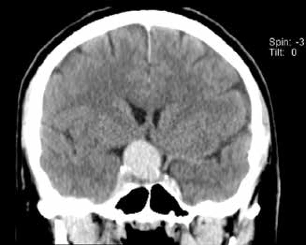 Frontální řez z CT angiografie