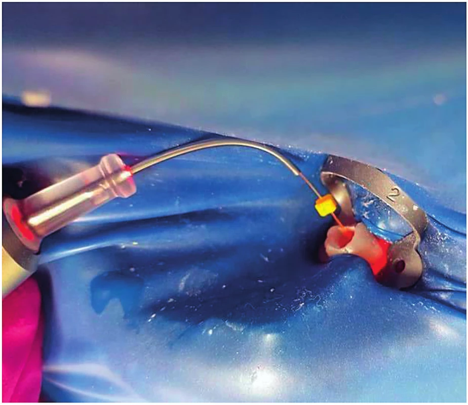 Endodoncia za pomoci diodového lasera vlnová dĺžka, infračervená dióda 970 nm (autor snímky:
Kyjovská Čičváková)