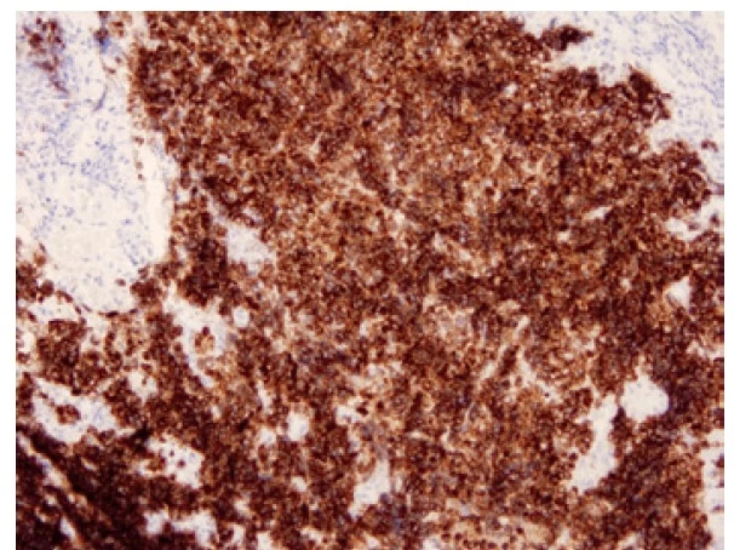 Malobuněčný karcinom pozitivní v imunohistochemickém průkazu
DLL3. 100x.