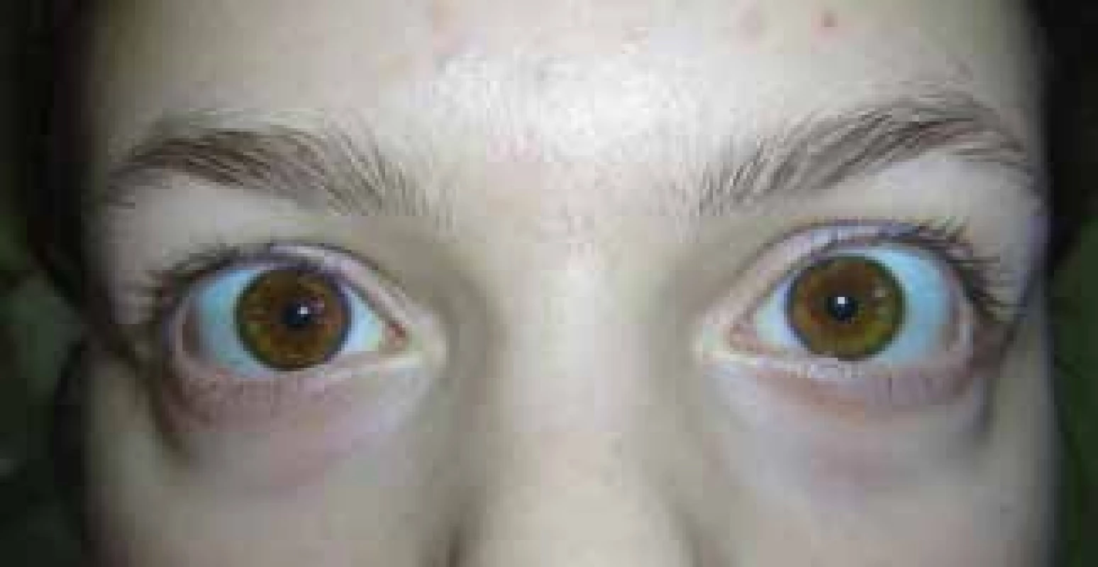 Normalisation of pupil width at follow-up examination
of patient one day later