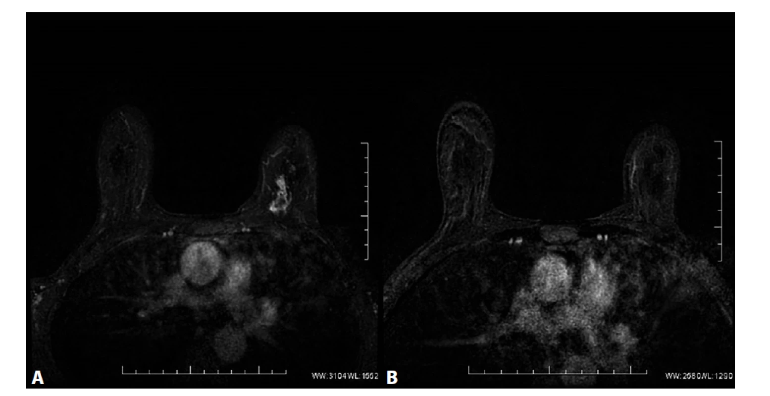 MRM. T1FS ax, kontrastní studie VIBRANT, 2. postkontrastní sekvence, subtrakce<br>
A) Před NCHT. Patologické sycení ložiskového typu v HVK l. sin odpovídající karcinomu. V centrálních oddílech tumoru
výpadek sycení odpovídající nekrotickým změnám ca. B) Po NCHT. Absence sycení po NCHT, bez průkazu rezidua
tumoru, rCR.<br>
Fig. 5: MRI, T1FS ax, contrast study VIBRANT, 2. postcontrast sequence, subtraction<br>
A) Before NCT. Pathological mass enhancement in the UIQ of left breast corresponding to carcinoma. Absence of enhancement
in the central part of the tumour corresponds to necrotic changes. B) After NCT. Absence of enhancement
after NCT, without detection of residual tumour, rCR.