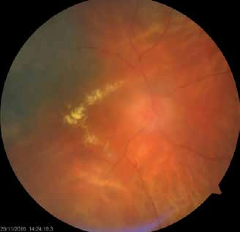 Patient with post-radiation optic neuropathy and
maculopathy